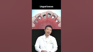 Niềng răng mắc cài mặt lưỡi | Nha Khoa Minh Châu