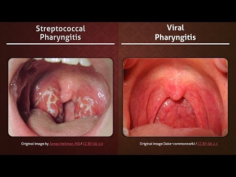 Streptococcal vs. Viral Pharyngitis