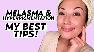 My Best Tips for Melasma \& Hyperpigmentation-Prone Skin | Skincare with Susan Yara