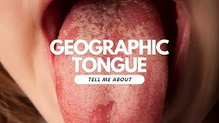 Geographic tongue