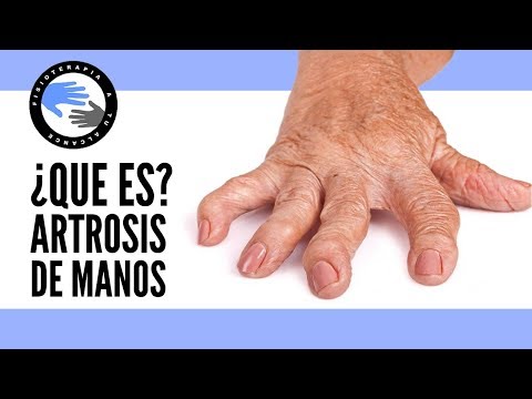 Vídeo: Cincha De Los Dedos: Causas Y Tratamientos