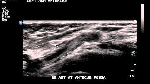 arm embolus ultrasound video.avi