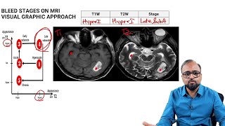 MRI: Intracranial Bleed Stages | Edition 8 Sample Video (Radiology)