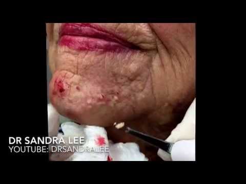 Milia & Blackheads TNTC: 1st Treatment. For Medical Education- NSFE.