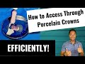 Efficient and Predictable Root Canal Procedure Through New Porcelain Crown