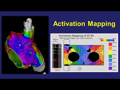 Video: Gruparea Semi-supravegheată A Electrogramelor Fracționate Pentru Cartografierea Atrială Electroanatomică