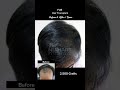 FUE Hair Transplant Before and After 1 Year 2,500 Grafts