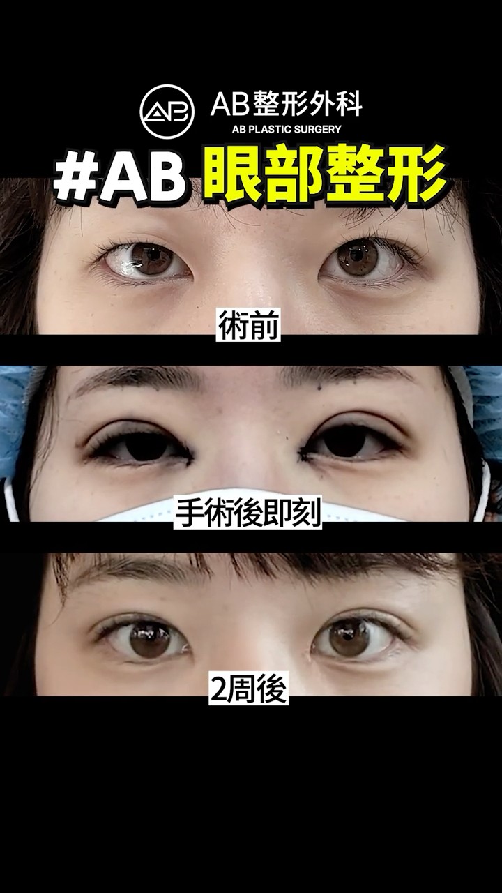 眼整形真實變化紀錄✨ #Shorts