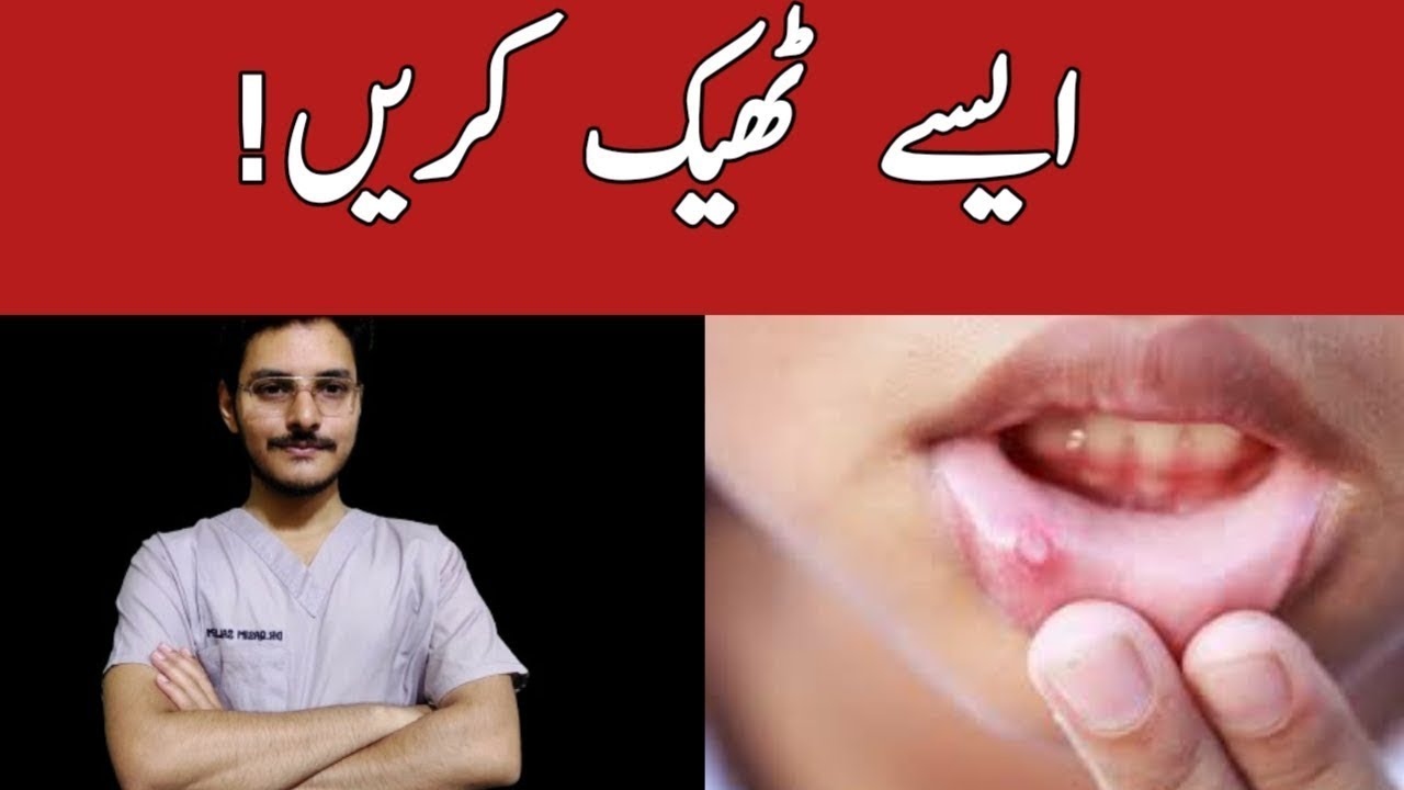 How To Recognise And Treat Mouth Ulcers (Getting Rid Of Canker Sores