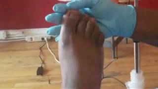 Foot Care Nurse at home Visit for Invulted Toenail Maintenance