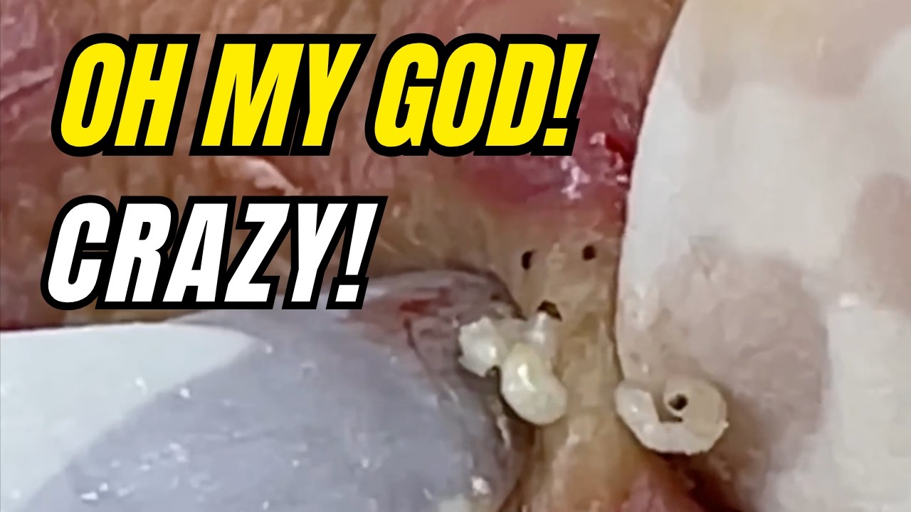 Can You Handle This Satisfying Blackhead Removal? YouTube