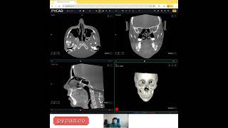 Custom web DICOM viewer for dental implant planning