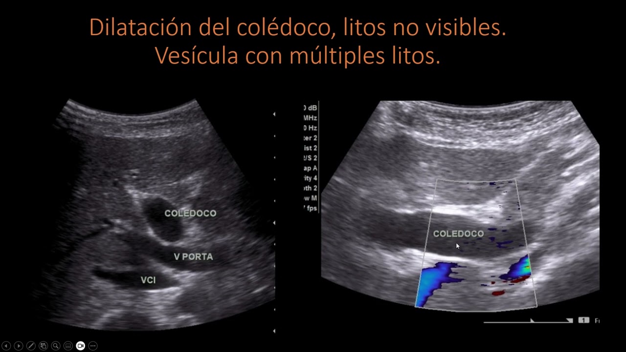 Ecografia del pancreas A