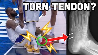 DOCTOR Explains how LeBron Played with a TORN Foot Tendon