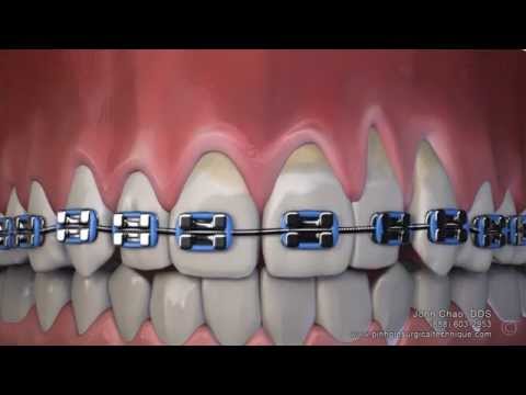 Videó: Lehetőség van fogíny kontúrozására fogszabályzóval?