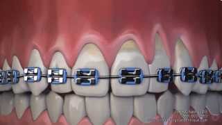 Can Braces Cause Gum Recession Blodgett Dental Care