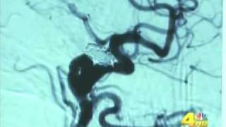 KNBC-Channel 4: "Saving Lives with 3-D Brain Scans"