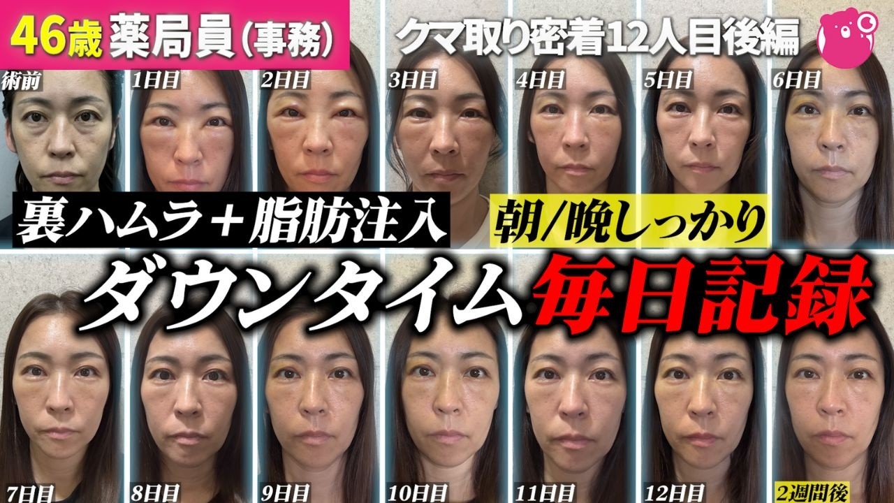 【裏ハムラ】目の下のクマ取りリアルなダウンタイム大公開！1カ月後の変化はいかに？【クマ取り密着12人目後編】#目の下のたるみをとる方法#美容整形 #湘南美容クリニック