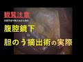 実際の手術写真をお見せします。胆石症の治療【医師解説】2022年最新版
