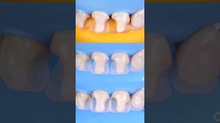 ??awesome work single day process before and after directcomposite teethfilling