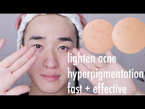 How I fade ACNE scars FAST! Easy Routine 