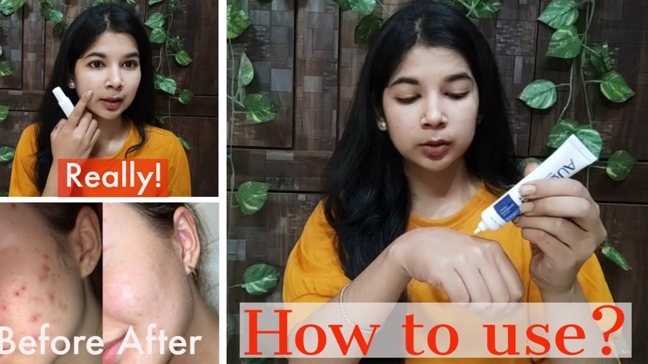 BioAqua Removal of Acne Cream Review/How To Use BioAqua To Get Rid Of