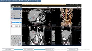 Philips IntelliSpace Portal clinical application MMTT (Multi Modality Tumor Tracking)