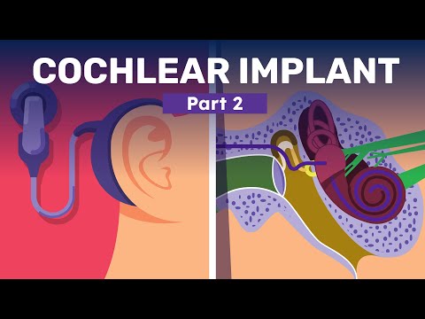 Vídeo: Quan van caure els teus implants mamaris?