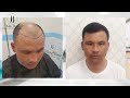 Результат пересадки волос / Hair transplant result