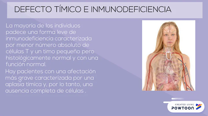 SINDROME DE DiGeorge