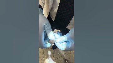 Zygomatic Implant Multi-Unit Abutment #implants