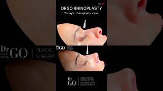 Rhinoplasty Operation Result