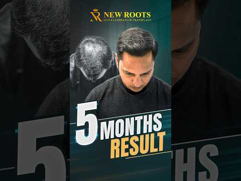 5 Months Later… Hair Transplant Result 😮 | Vashi/Navi Mumbai #hairtransplantresult #shorts