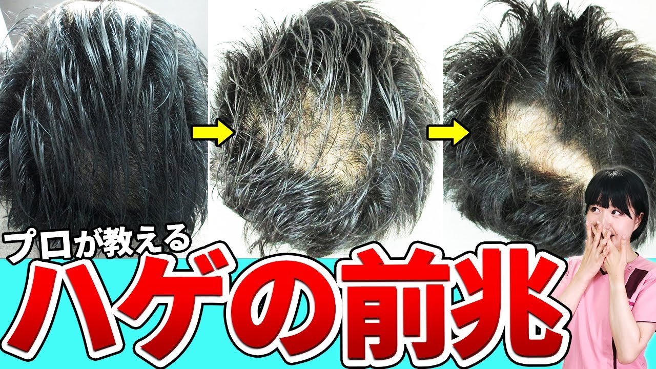 【要確認】ハゲの前兆はコレ!対策と原因を解説 - YouTube