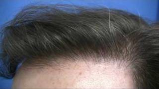 Best hair transplant - Dr Hasson - 5234 Grafts - 1 Session