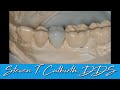 How to Make Perfect Interproximal Contacts - with Steven T. Cutbirth, DDS