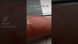 Fui Mordida Por Um Zumbi