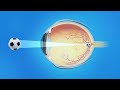 Nearsightedness myopia