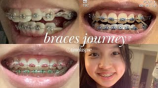 Braces Overbite Time lapse (with extractions)