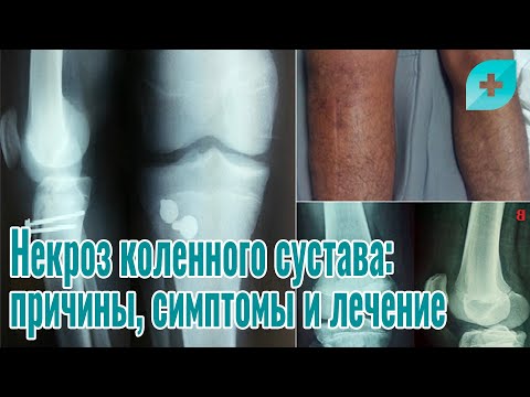 Некроз коленного сустава: причины, симптомы и лечение