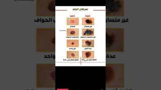 سرطان  الجلد        الخبيث  الحميد       ترند           مختبرات طبية  يومياتي  طب           سمعها
