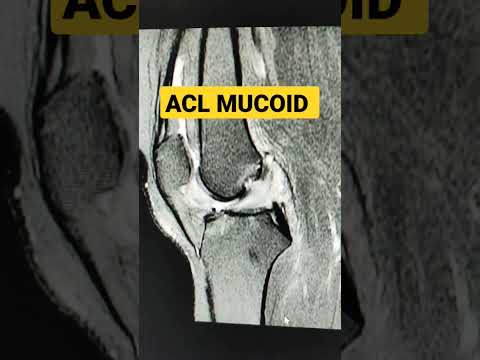 ACL Mucoid #shorts #mri #trendingshorts