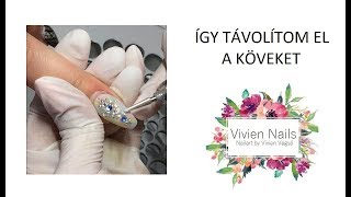 ÍGY TÁVOLÍTOM EL A KÖVEKET