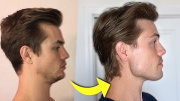 My Chin Used to Be Recessed—Here’s How I Fixed It