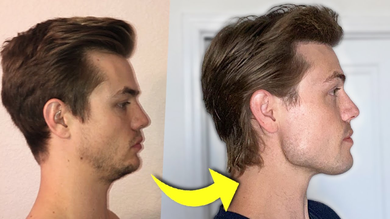 How I Fixed My Receding Chin Youtube