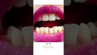 SMILE MAKEOVER 😃😃📍 YASHVI DENTAL CLINICDr Devarshi Das call-6026301369