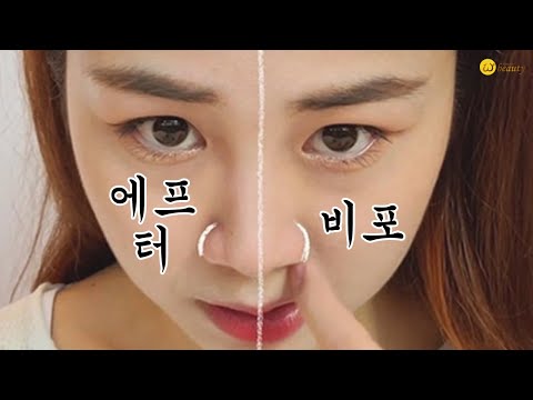 날벌레 들어가는 #콧구멍 주목 #<strong>콧볼축소</strong> #콧볼줄이기 셀프마사지 위뷰티 #내손성형라이브 175회