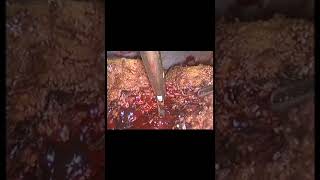 Kapalı Yöntem Ile Karaciğer Ameliyatı