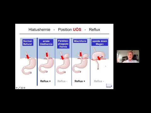 Video: 3 Möglichkeiten, um zu wissen, ob Sie eine Hiatushernie haben