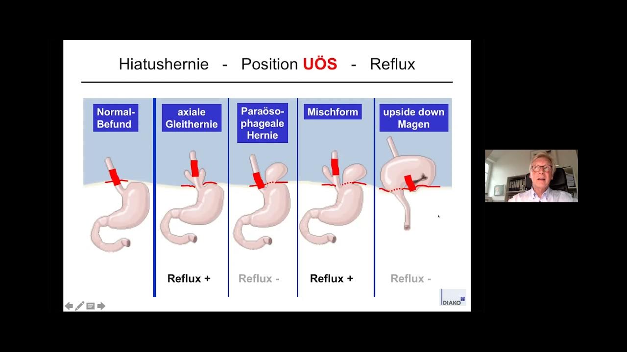 Hiatus Hernien & die verschiedenen OPTechniken der modernen Hernienchirurgie YouTube